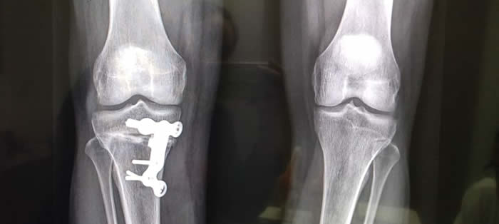 Osteotomía de la rodilla